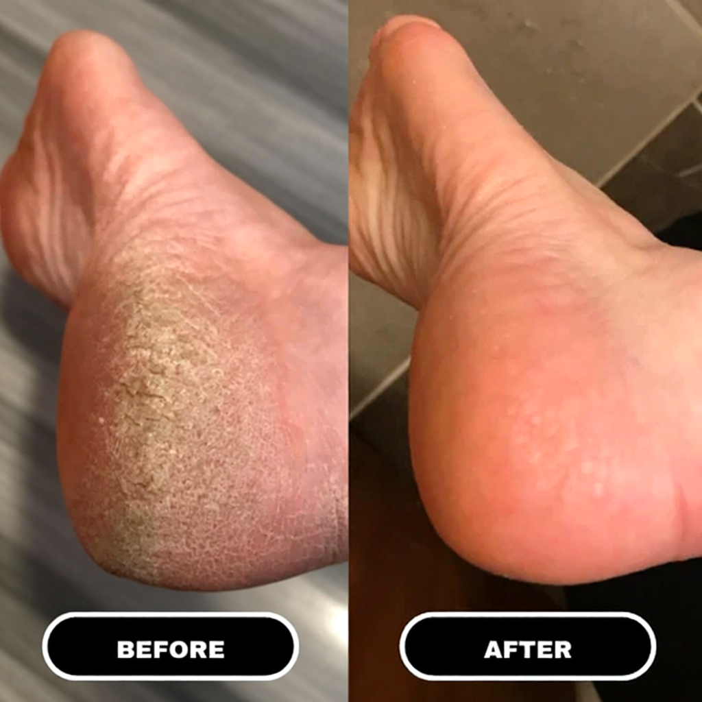 HeelWell Pain Relief Stick